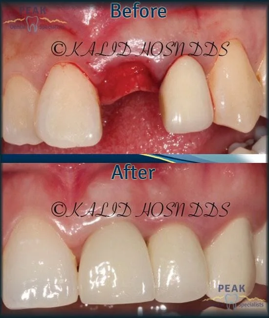 Periodontic Before and After