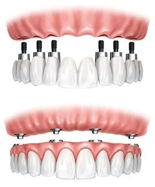 illustration of implant-supported dentures, implant dentist Dayton, OH dental implants