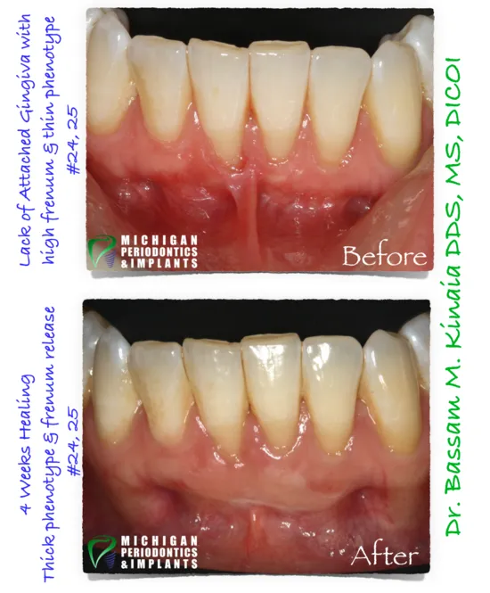 Dental Implants Washington Township