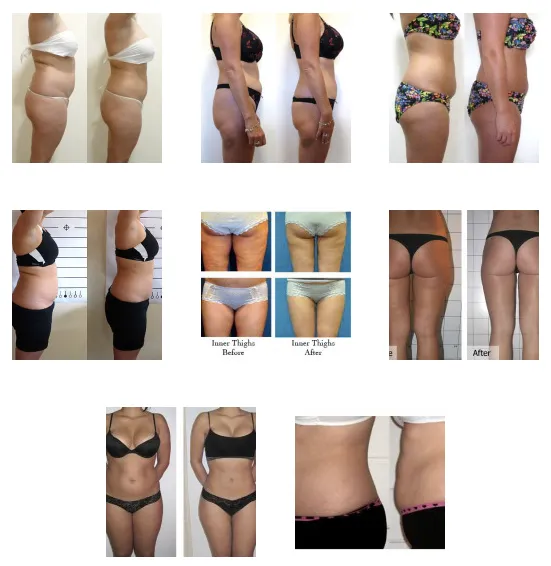My-Lipo by Lipo Light in Vienna | MyChiropractic Doctor