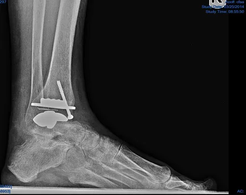 Ankle Implant