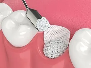 illustration of bone grafting on tooth before implant placement, dentist Sherman Oaks, CA dental implants