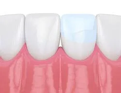 illustration of row of teeth, one tooth with bonding repairing crack - cosmetic dentistry Brookline, MA dental bonding