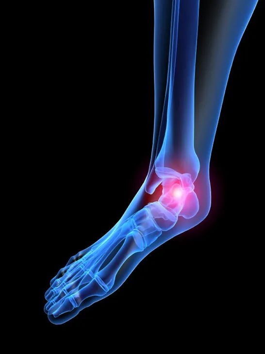 heel pain plantar fasciitis