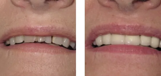 mini-dental-implants