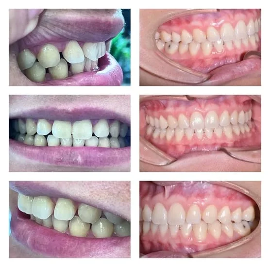 collage of images showing person's mouth before and after getting Same-visit BruxZir NOW crowns, dental crowns Honolulu, HI dentist