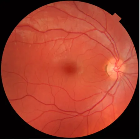 retinal screening photo