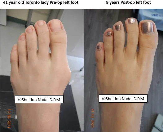 Before and After - Bunions/Bunionettes - Sheldon H. Nadal, D.P.M.