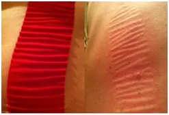 Kinesio Taping Overview