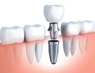 illustration of row of teeth with dental implant parts being assembled to replace missing tooth, cosmetic dentist Beverly Grove Los Angeles, CA dentist