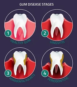 Gum Disease Bridgeport & Fairfield