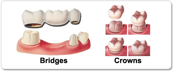 crowns | Dentist in Saluda, SC | Saluda Smilemakers