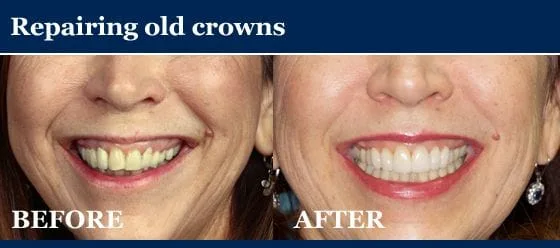 before and after picture - repairing old crowns