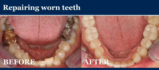 repairing worn teeth