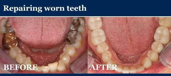 repairing worn teeth