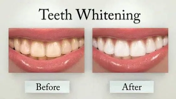 Teeth Whitening Inglewood, CA