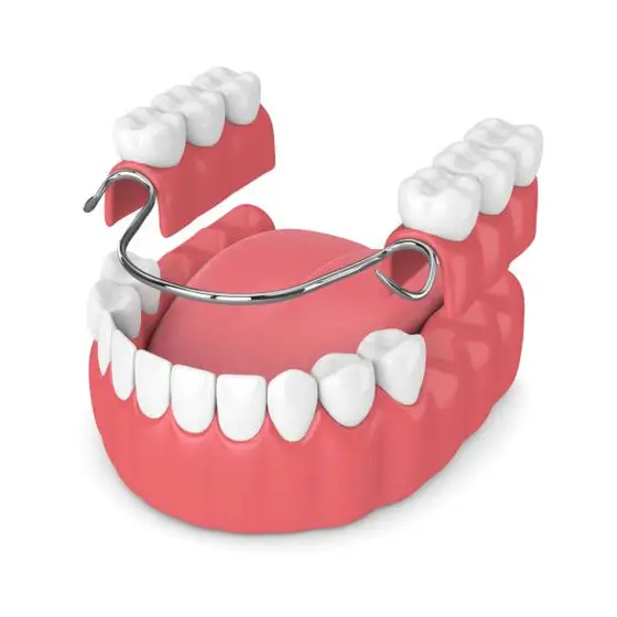illustration of partial denture being placed in mouth, dentures Melrose, MA dentist