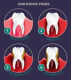 illustration "Gum Disease Stages" showing teeth as periodontal disease progresses, treatment for gum disease Boulder, CO dentist 