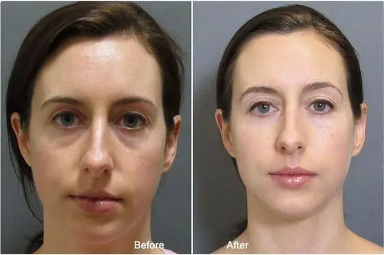 juvederm-img