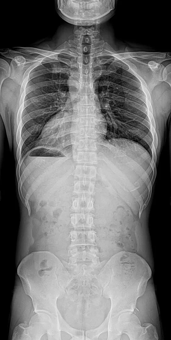 Full spine x-ray