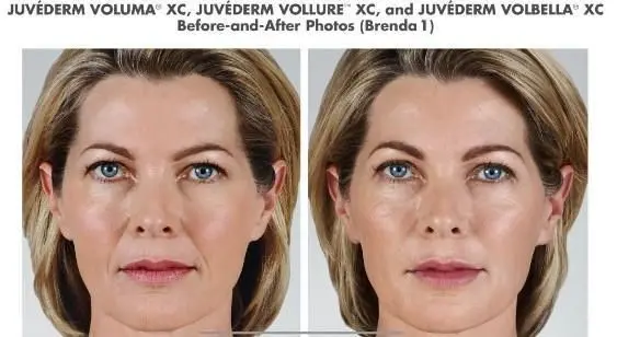 juvederm-img