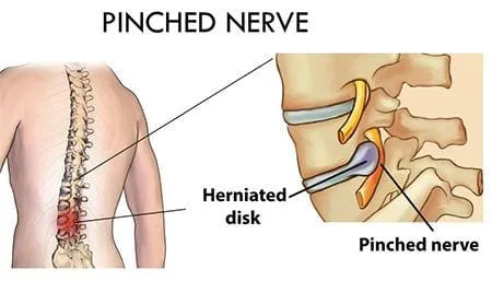 Pinched Nerve
