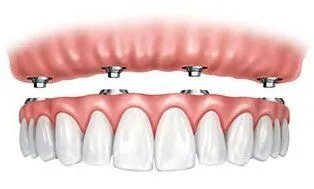 implant dentures replacing entire upper arch of teeth, dental implants Lawrenceville, GA family dentist