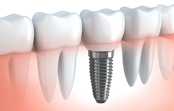 Dental Implants, Falls Church VA Dentist Periodontist