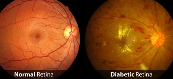 normal retina eye vs diabetic retinopathy