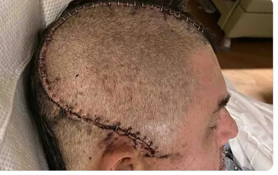 Ray Ortiz Hemorrhage Brain Surgery