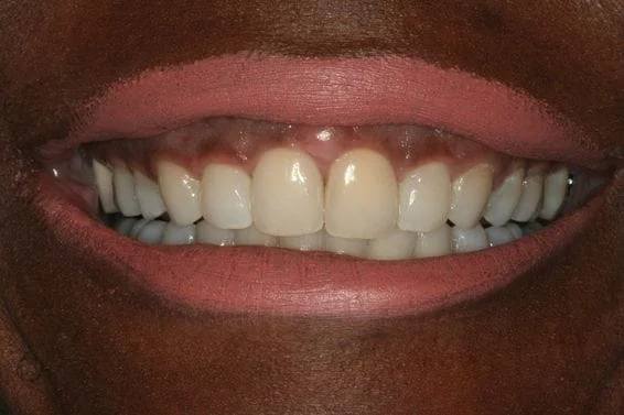 Space Closure with Invisalign - After