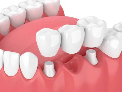 3D illustration of teeth in mouth, dental bridge being placed over abutment teeth, dentist Wauwatosa family dentistry