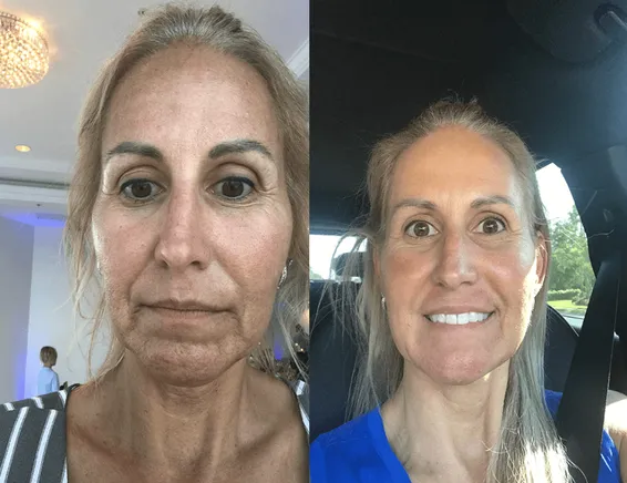 skin rejuvenation before and after 3