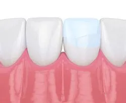 illustration of row of teeth, one tooth with dental bonding Financial District, NY dentist