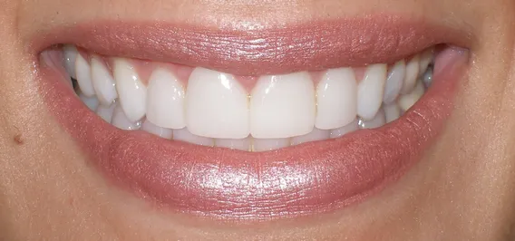 Veneers by Dr. Stern