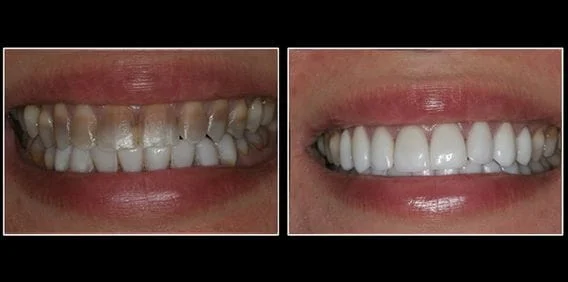 Dental Veneers Before and After Lansing, MI