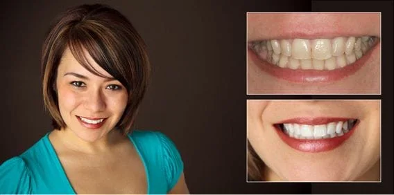 teeth whitening before and after dentist in lansing, mi
