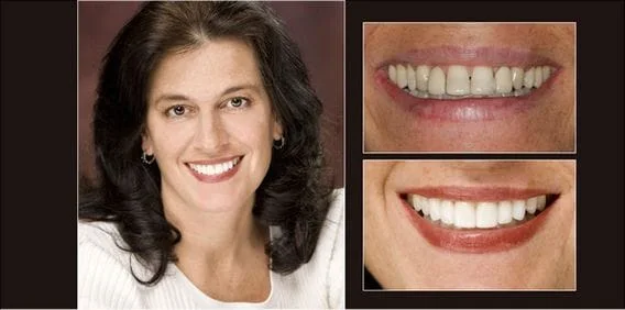 teeth whitening before and after Lansing, MI dentist