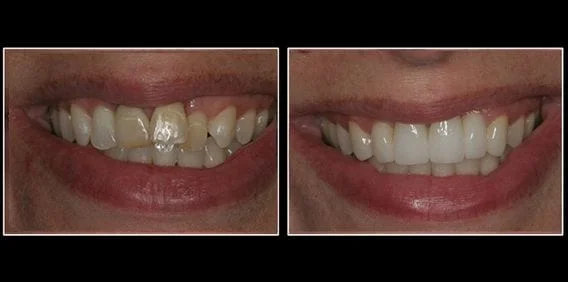 dental crowns before and after lansing, mi dentist
