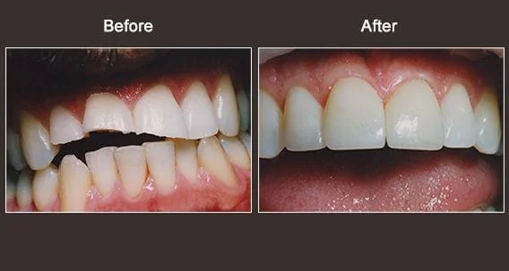 Cosmetic Dentistry Syracuse Before And After
