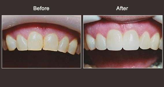 Cosmetic Dentistry Syracuse Before and After