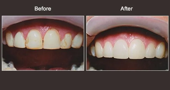Cosmetic Dentist Syracuse Before and After