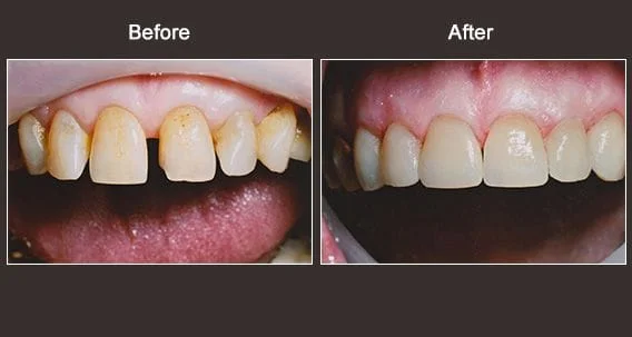 Cosmetic Dentist Syracuse NY Before And After