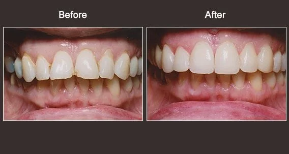 Cosmetic Dentist Syracuse NY Before and After