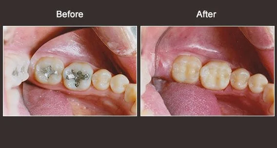 Dentist Syracuse NY Before And After