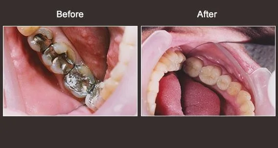 Dentist Syracuse NY Before and After photos