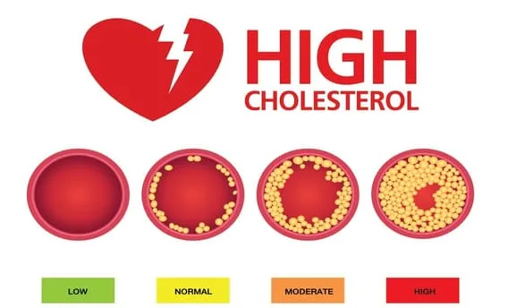 High Cholesterol in Orange City FL