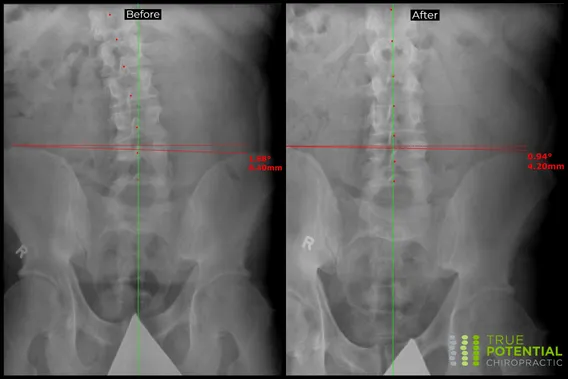 Xray Image