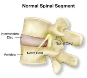 Herniated_Disc.jpg