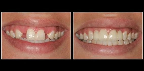 dental crowns before and after lansing, mi dentist